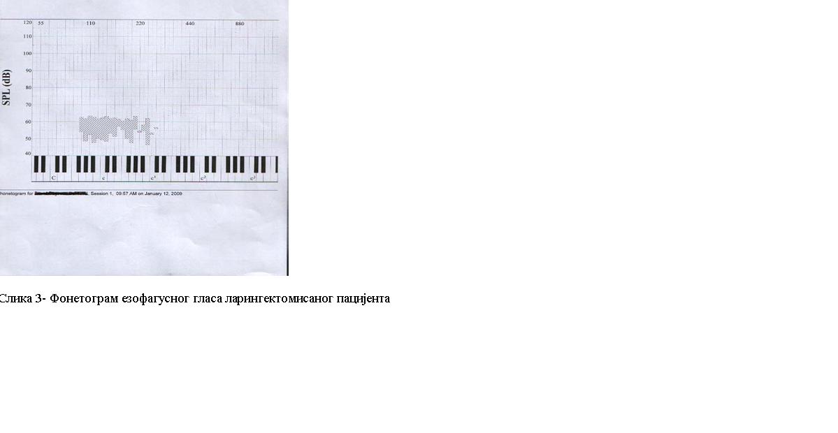 fonetogram of larygenctomised patients oesophageal voice